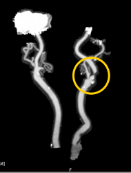 Carotid Artery Stenosis - CTisus CT Scan