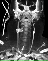 Trauma to Carotid Artery With Bleed - CTisus CT Scan