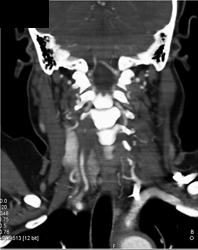 Vasculitis - CTisus CT Scan