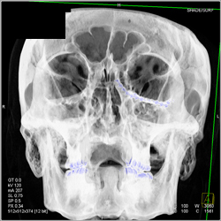 Orbital Fracture With Repair in Multiple Perspectives - CTisus CT Scan