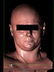 3D of the Face With VRT - CTisus CT Scan