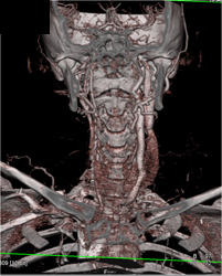 Occluded Right Carotid Artery - CTisus CT Scan