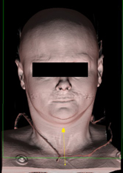 3D of Facial Expression - CTisus CT Scan