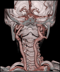 Ectatic Carotid Artery - CTisus CT Scan