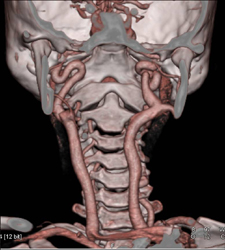 Ectatic Carotid Artery in Loeys-dietz Syndrome - CTisus CT Scan