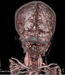 Intracranial Circulation - CTisus CT Scan