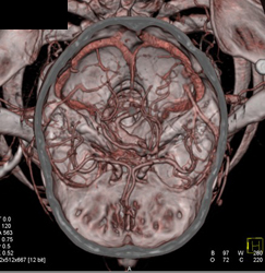 Basilar Artery Aneurysm - CTisus CT Scan