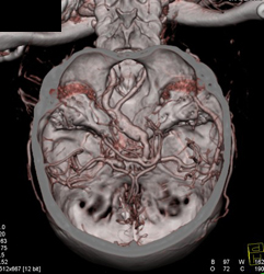 Ectatic Basilar Artery in Loeys-dietz Syndrome - CTisus CT Scan