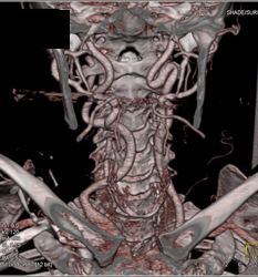 Cranial Fractures - CTisus CT Scan