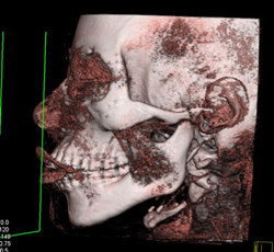 Soft Tissue Renderings of the Face - CTisus CT Scan