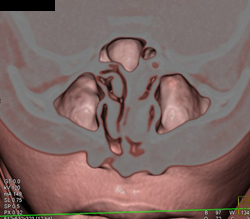 Sinuses With Minimal Sinusitis - CTisus CT Scan