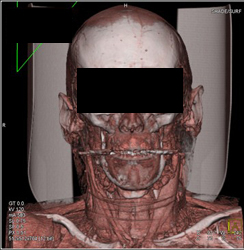 3D of the Face - CTisus CT Scan