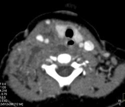 Abscess in Right Cervical Region - CTisus CT Scan