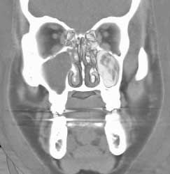 Maxillary Sinusitis - CTisus CT Scan