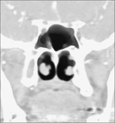 Thickened Septum - CTisus CT Scan