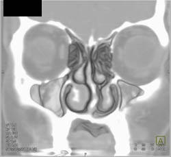 Mild Sinusitis - CTisus CT Scan