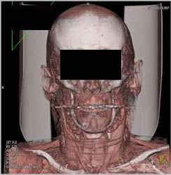 Muscles of the Face and Neck - CTisus CT Scan