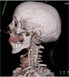 Loeys-deitz Syndrome - CTisus CT Scan