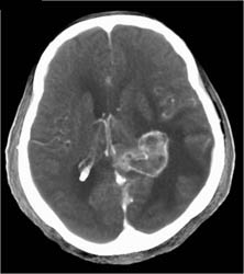 Glioblastoma - CTisus CT Scan