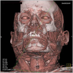 Facial Muscles and Bone - CTisus CT Scan