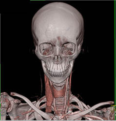 Jugular Vein - CTisus CT Scan