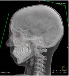 3D Rendering to Show Hair - CTisus CT Scan