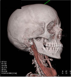 Normal Carotid Artery - CTisus CT Scan