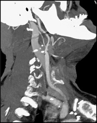 Carotid Artery Stenosis - CTisus CT Scan