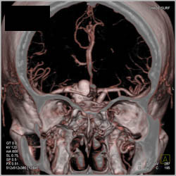 Aneurysm Well Seen on CTA - CTisus CT Scan