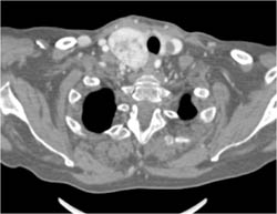 Substernal Thyroid and Left JV Clot - CTisus CT Scan