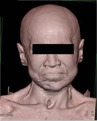 Good Facial Anatomy - CTisus CT Scan