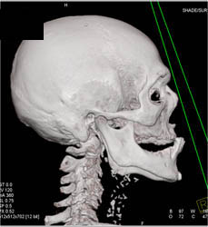 Brain Rock - CTisus CT Scan