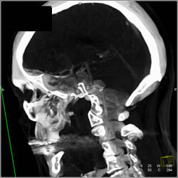 CTA of Circle of Willis and Carotids That Are Ectatic in Loeys-dietz Syndrome - CTisus CT Scan