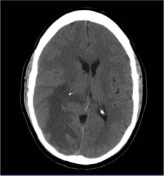 Sarcoidosis Simulates An Infarct- RSNA Film Panel Case 2008 - CTisus CT Scan