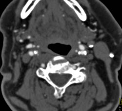 Carotid Artery Stenosis With Ulcer - CTisus CT Scan