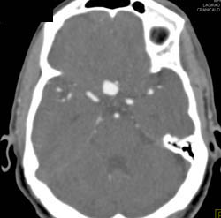 Intracranial Aneurysm - CTisus CT Scan