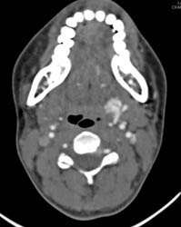 Bleed From Carotid Artery S/P Trauma - CTisus CT Scan