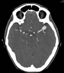 Middle Cerebral Artery (MCA) Aneurysm - CTisus CT Scan