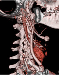 Normal Carotid Artery - CTisus CT Scan