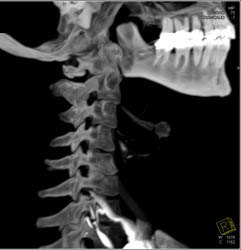 Normal Carotid Artery - CTisus CT Scan