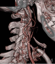 Carotid Stenosis - CTisus CT Scan