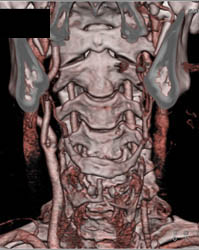 Carotid Stenosis - CTisus CT Scan