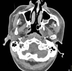 Sinusitis - CTisus CT Scan