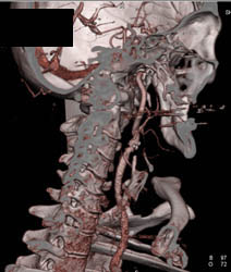 Sinusitis - CTisus CT Scan