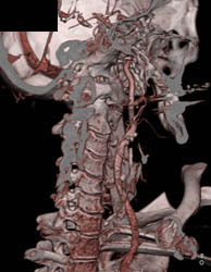 Sinusitis - CTisus CT Scan