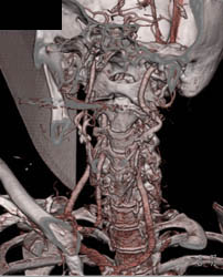 Sinusitis - CTisus CT Scan