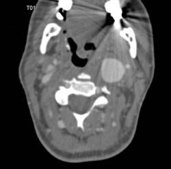 Pseudoaneurysm - CTisus CT Scan