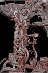 Carotid Stenosis - CTisus CT Scan