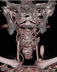 Carotid Stenosis - CTisus CT Scan