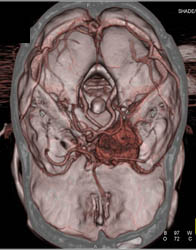 Intracranial Tumor - CTisus CT Scan